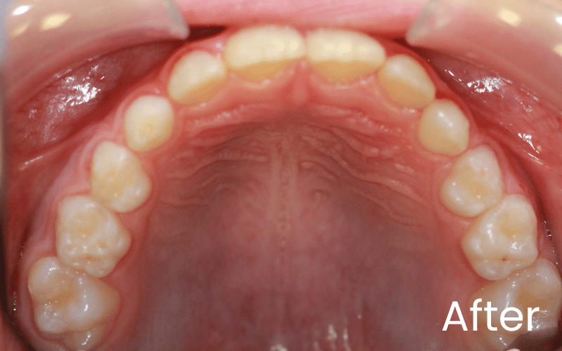 Children’s Braces - Hampshire Dentists Pain Free Dentist in Southampton Image of all upper teeth and palate after straightening with Invisalign First in Southampton