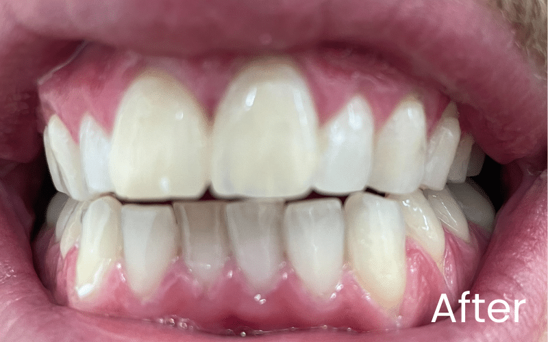Teeth Whitening - Hampshire Dentists Pain Free Dentist in Southampton Image of close up smile after teeth whitening treatment in Southampton