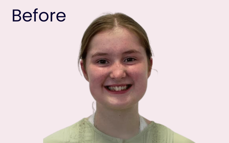 Children’s Braces - Hampshire Dentists Pain Free Dentist in Southampton Image of patient before starting straightening with Invisalign as a teenager