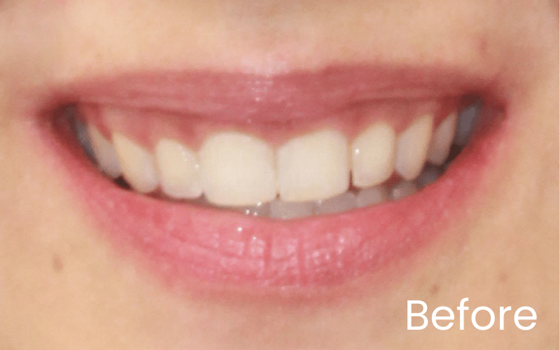 Teeth Whitening - Hampshire Dentists Pain Free Dentist in Southampton Image of close up smile before teeth whitening treatment