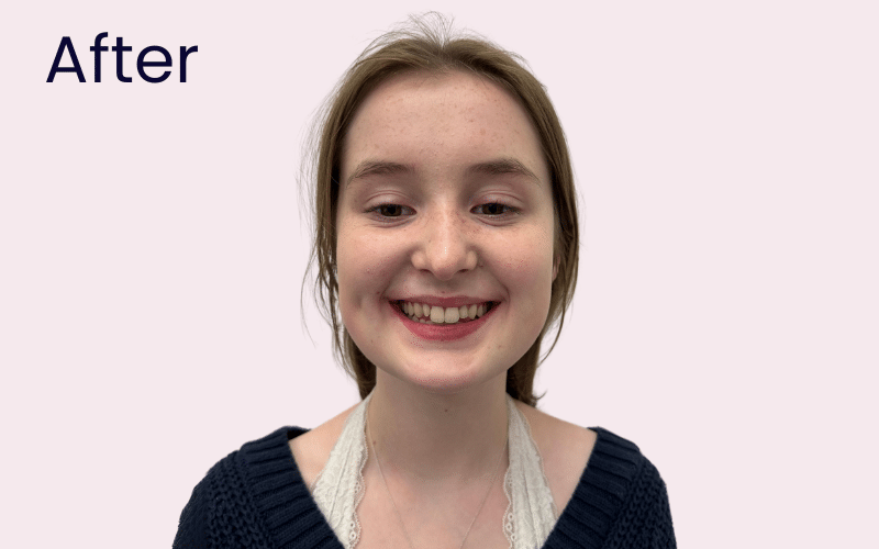 Children’s Braces - Hampshire Dentists Pain Free Dentist in Southampton Image of patient after straightening with Invisalign as a teenager