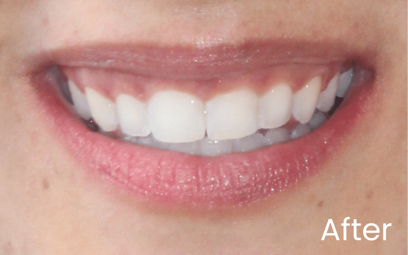 Teeth Whitening - Hampshire Dentists Pain Free Dentist in Southampton Image of close up smile after teeth whitening treatment
