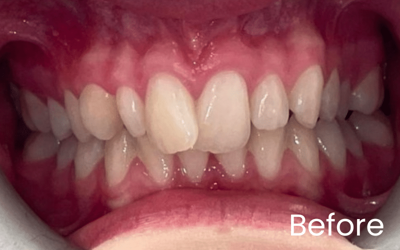 Children’s Braces - Hampshire Dentists Pain Free Dentist in Southampton Children’s Braces - Hampshire Dentists Pain Free Dentist in Southampton