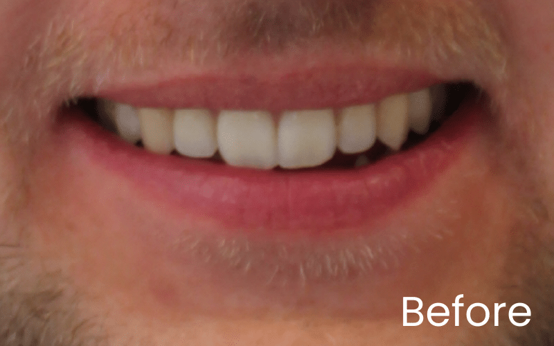 Teeth Whitening - Hampshire Dentists Pain Free Dentist in Southampton Image of close up smile before teeth whitening treatment at Hampshire Dentists