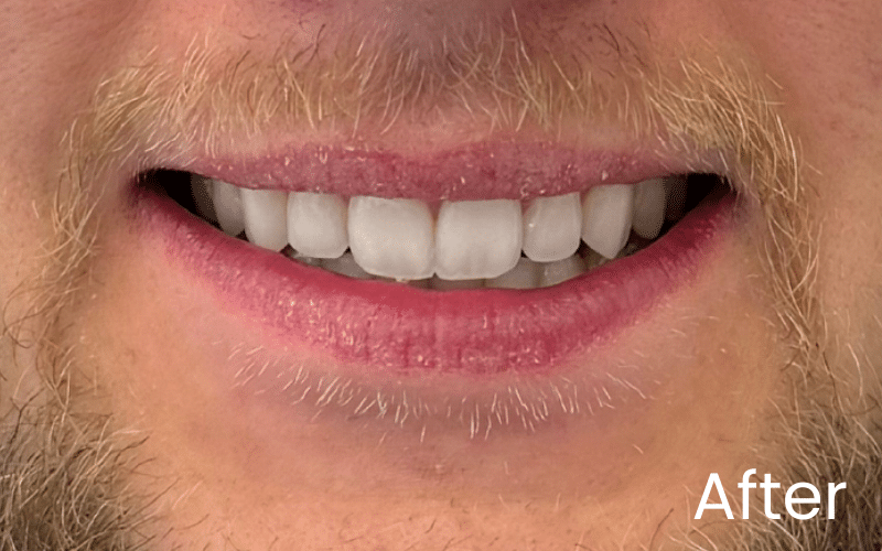 Teeth Whitening - Hampshire Dentists Pain Free Dentist in Southampton Image of close up smile after teeth whitening treatment at Hampshire Dentists