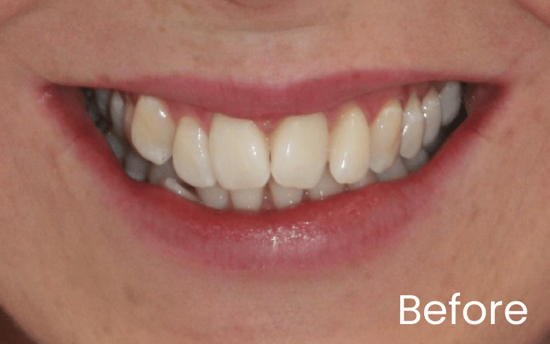 Teeth Whitening - Hampshire Dentists Pain Free Dentist in Southampton Image of close up smile before teeth whitening and straightening treatment