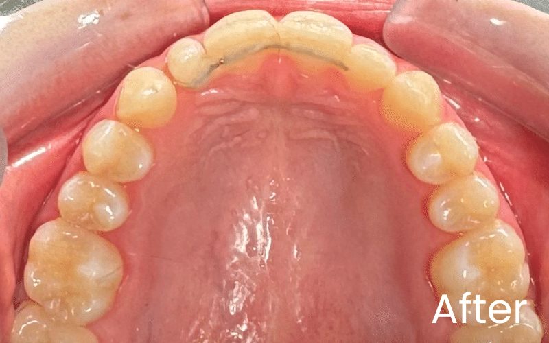 Children’s Braces - Hampshire Dentists Pain Free Dentist in Southampton Image of all upper teeth and palate after straightening with Invisalign in Southampton