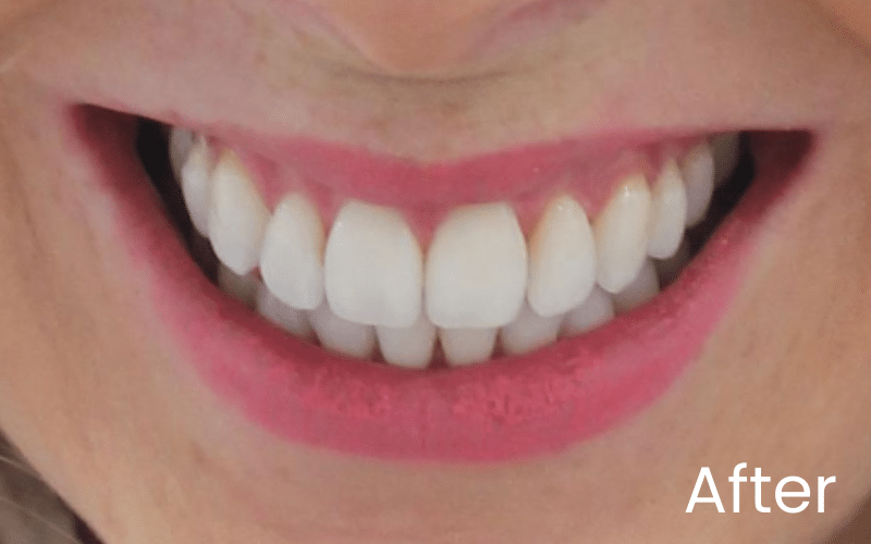 Teeth Whitening - Hampshire Dentists Pain Free Dentist in Southampton Image of close up smile after teeth whitening and straightening treatment