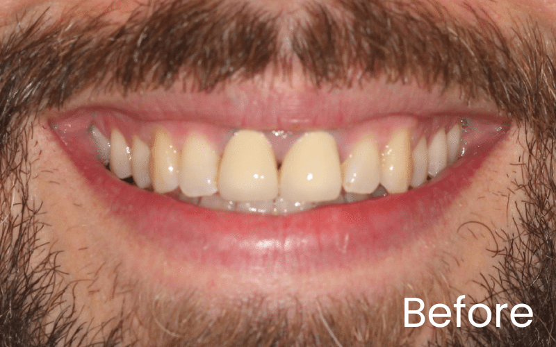 Teeth Whitening - Hampshire Dentists Pain Free Dentist in Southampton Image of close up smile before teeth whitening in Southampton