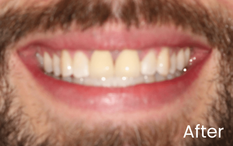 Teeth Whitening - Hampshire Dentists Pain Free Dentist in Southampton Image of close up smile after teeth whitening in Southampton