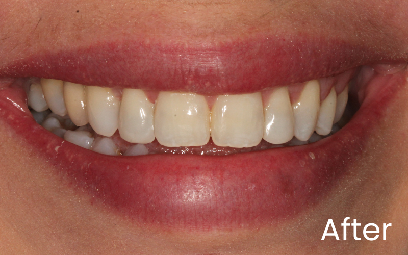 Image of close up smile after composite bonding treatment