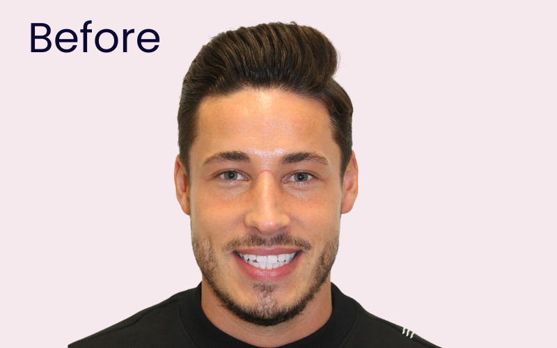 Image of patient before composite bonding treatment