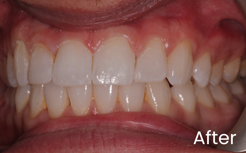 Left retracted image of teeth before composite bonding treatment at Hampshire Dentists