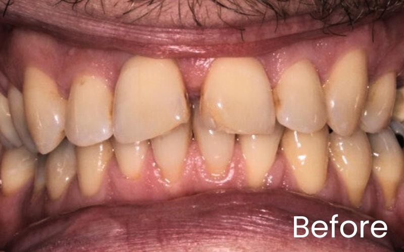 Dental Veneers - Hampshire Dentists Pain Free Dentist in Southampton Front full retracted image of teeth before veneer treatment