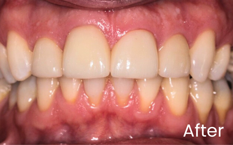 Dental Veneers - Hampshire Dentists Pain Free Dentist in Southampton Front full retracted image of teeth after dental veneer treatment for the front 6 teeth