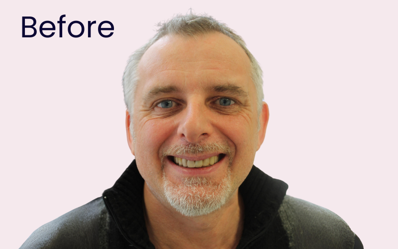 Dental Veneers - Hampshire Dentists Pain Free Dentist in Southampton Dental Veneers - Hampshire Dentists Pain Free Dentist in Southampton
