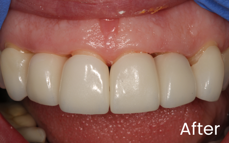 Dental Veneers - Hampshire Dentists Pain Free Dentist in Southampton Front full retracted image of teeth after dental veneer treatment at Hampshire Dentists