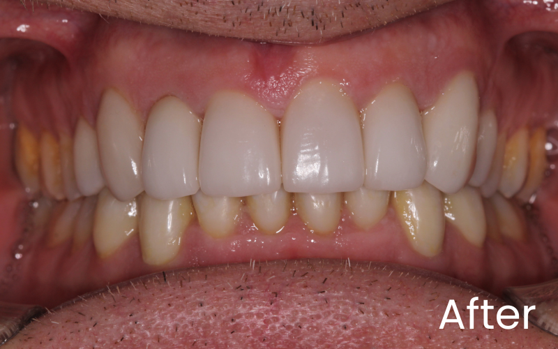 Dental Veneers - Hampshire Dentists Pain Free Dentist in Southampton Dental Veneers - Hampshire Dentists Pain Free Dentist in Southampton