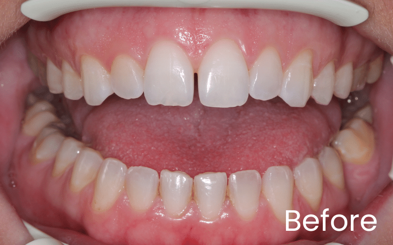 Gum Contouring - Hampshire Dentists Pain Free Dentist in Southampton Front full image of teeth before gum contouring treatment