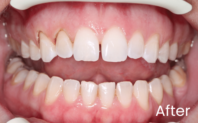 Gum Contouring - Hampshire Dentists Pain Free Dentist in Southampton Front full image of teeth after gum contouring treatment
