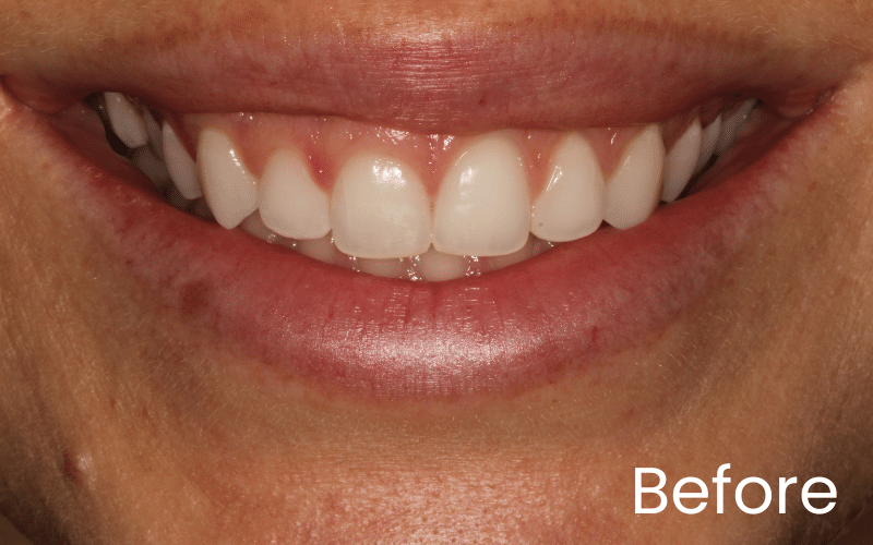 Gum Contouring - Hampshire Dentists Pain Free Dentist in Southampton Image of close up smile before gum contouring treatment