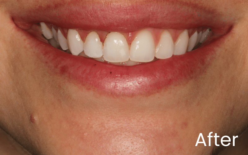 Gum Contouring - Hampshire Dentists Pain Free Dentist in Southampton Image of close up smile after gum contouring treatment
