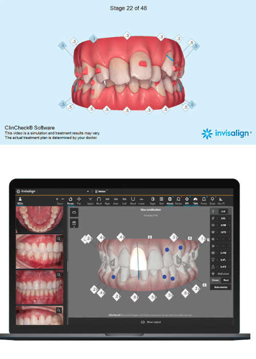 Invisalign - Hampshire Dentists Pain Free Dentist in Southampton Image collage of Clincheck software showing the planning of Invisalign aligner movement