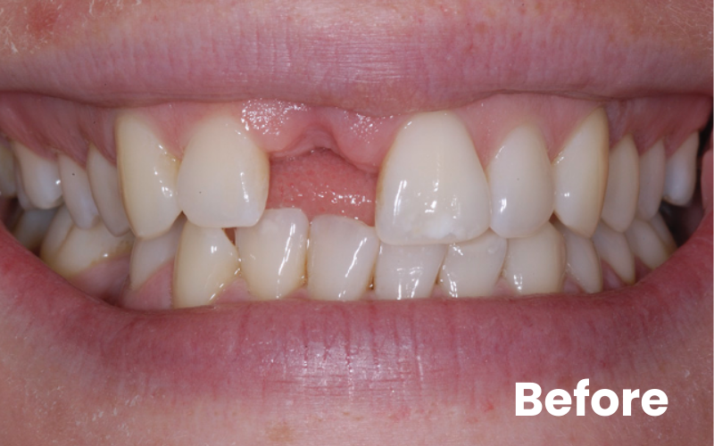 Missing front tooth before dental implant treatment