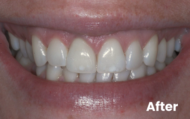 Front tooth replaced with dental implant