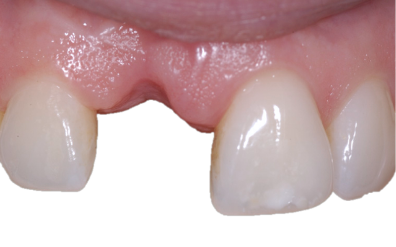Front missing tooth before dental implant treatment