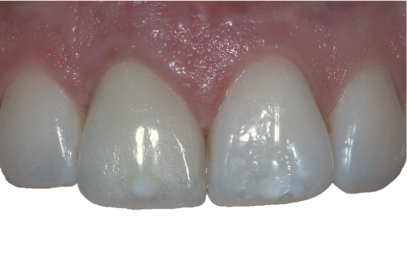 Front tooth replaced with dental implant