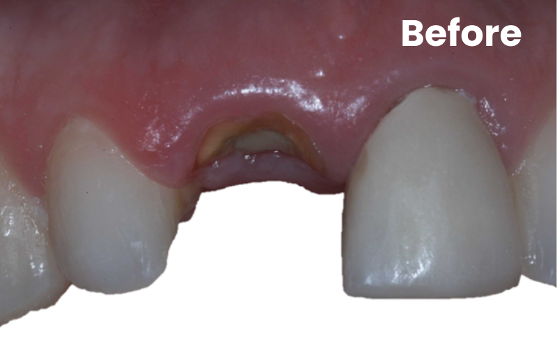 Front broken tooth before dental implant treatment