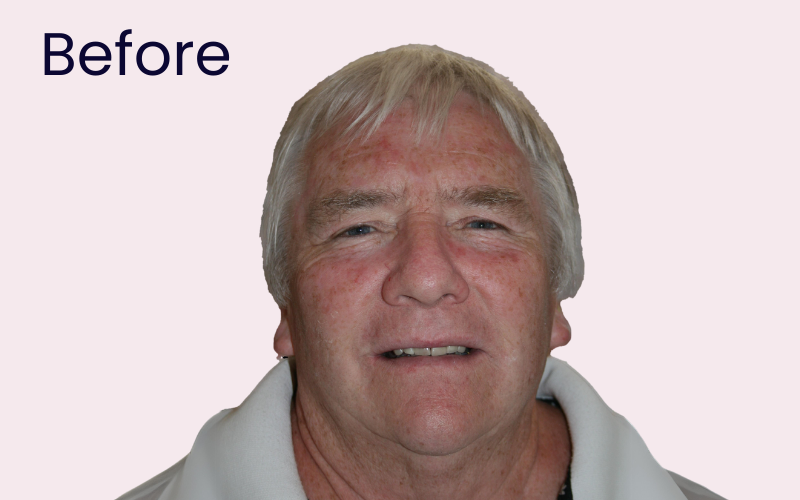 Image of patient before undergoing dental implant treatment to replace missing back teeth 