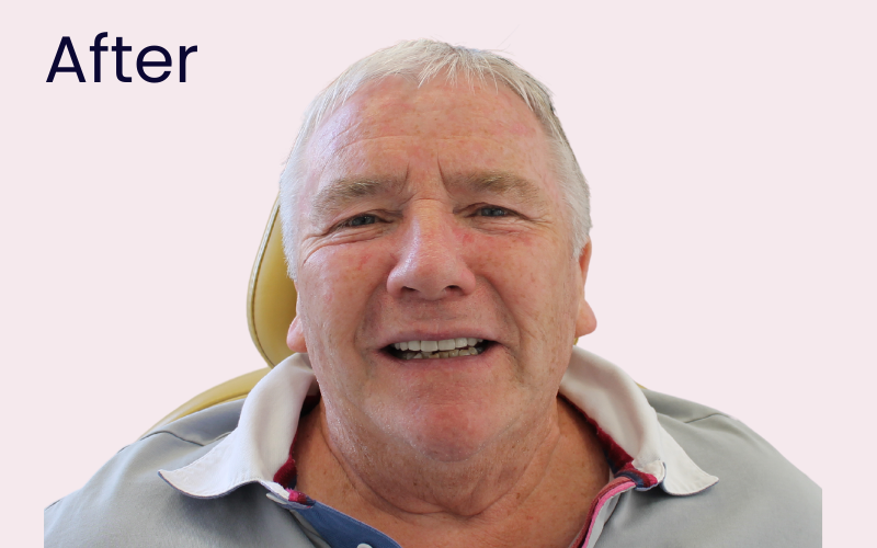 Image of patient after undergoing dental implant treatment to replace missing back teeth