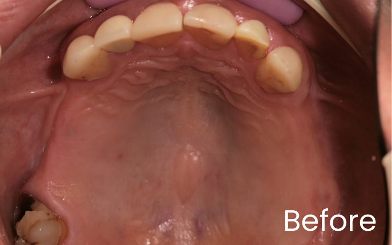 View of upper teeth and palate showing multiple missing back teeth