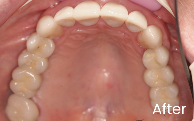 View of upper teeth and palate showing transformation with dental crowns and implant retained bridges