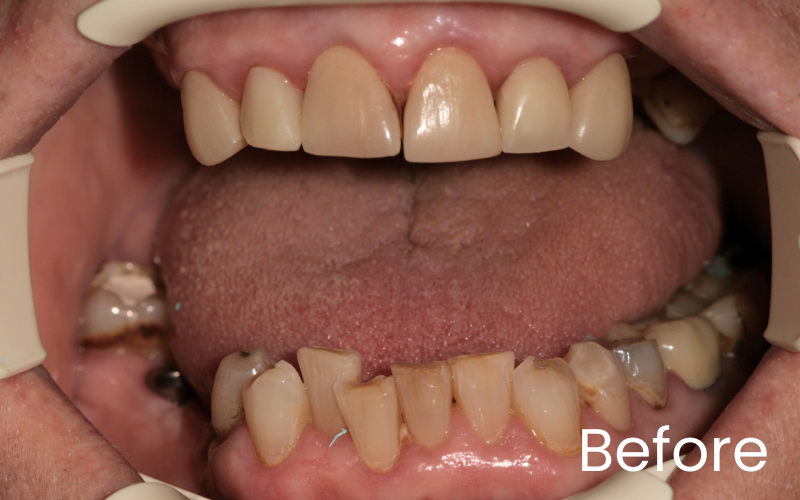 Multiple teeth implants - Hampshire Dentists Pain Free Dentist in Southampton