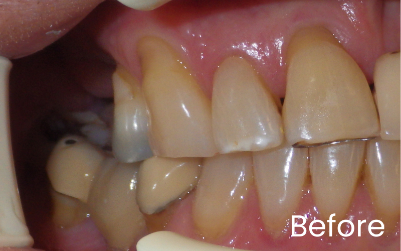 Right retracted view of teeth showing missing upper back teeth