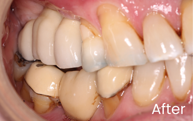 Right retracted view of teeth showing replacement of upper back teeth with an implant bridge