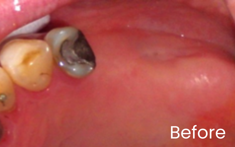 Multiple teeth implants - Hampshire Dentists Pain Free Dentist in Southampton