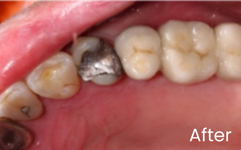 View of upper right palate and with replacement dental implant bridge in place