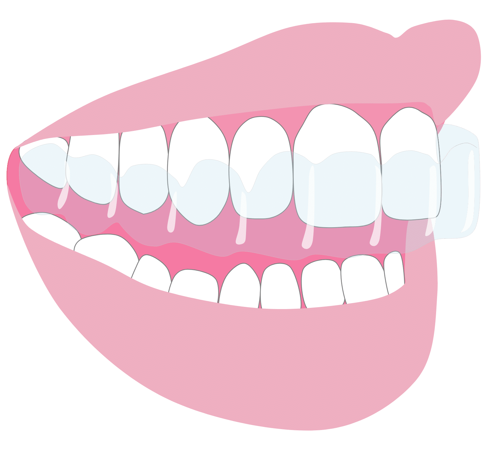 Straight Teeth Options - Hampshire Dentists Pain Free Dentist in Southampton Straight teeth options: graphic representation of Invisalign aligner on teeth