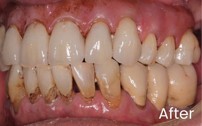 Left retracted view of teeth after replacement of lower left back teeth with implant bridge
