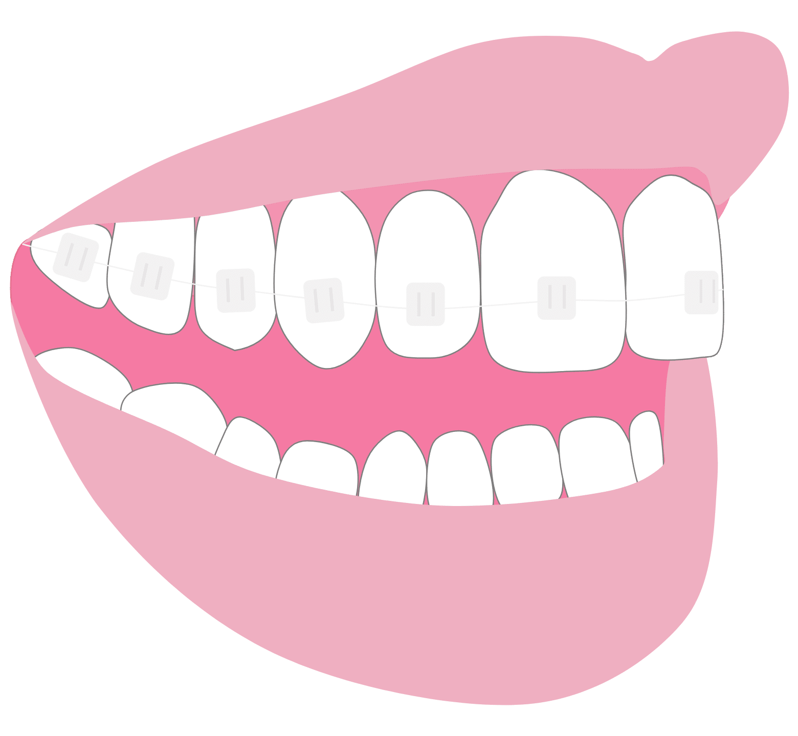Straight Teeth Options - Hampshire Dentists Pain Free Dentist in Southampton Straight teeth options: graphic representation of clear fixed braces on teeth