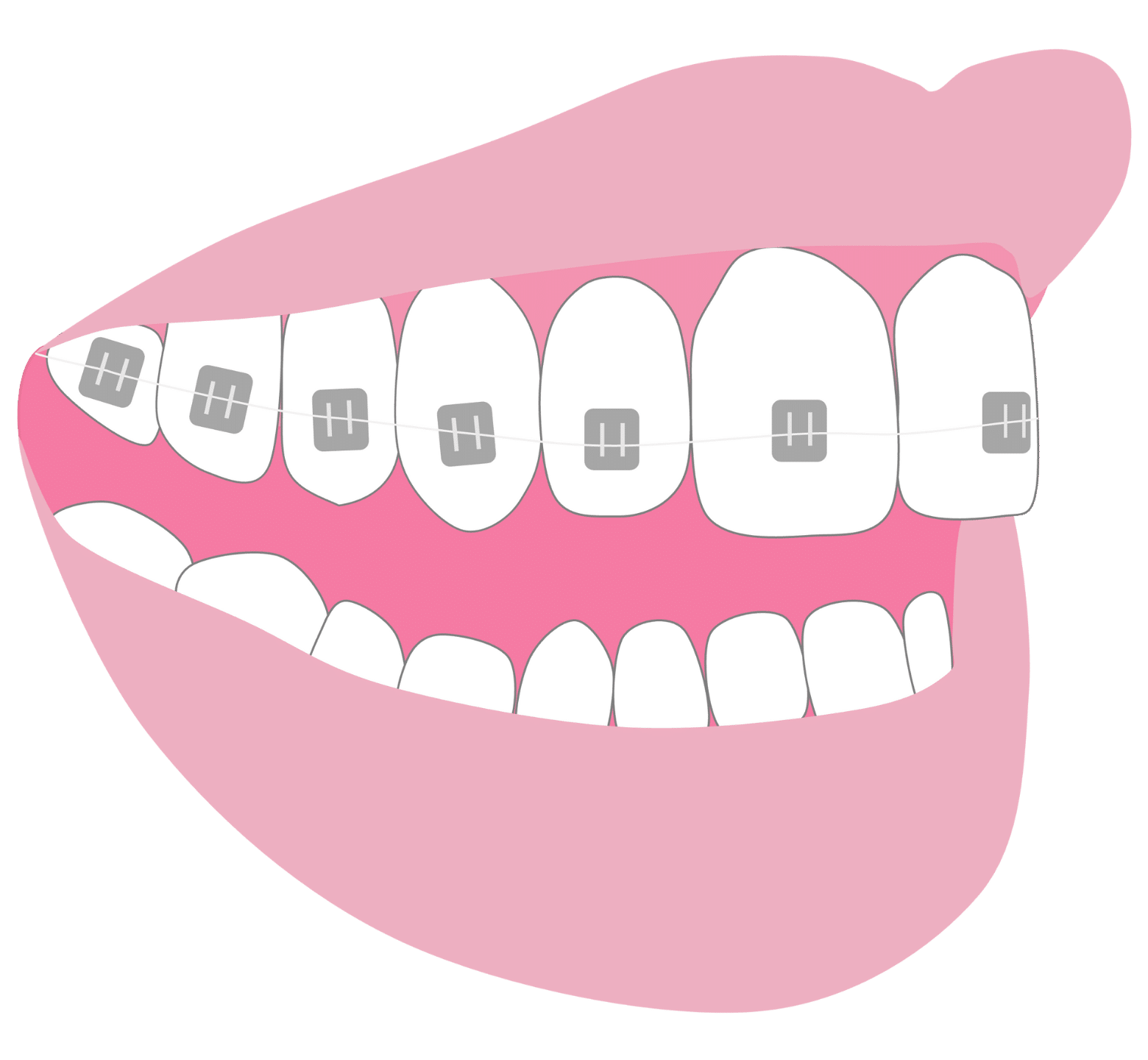 Straight Teeth Options - Hampshire Dentists Pain Free Dentist in Southampton Straight teeth options: graphic representation of metal fixed braces on teeth