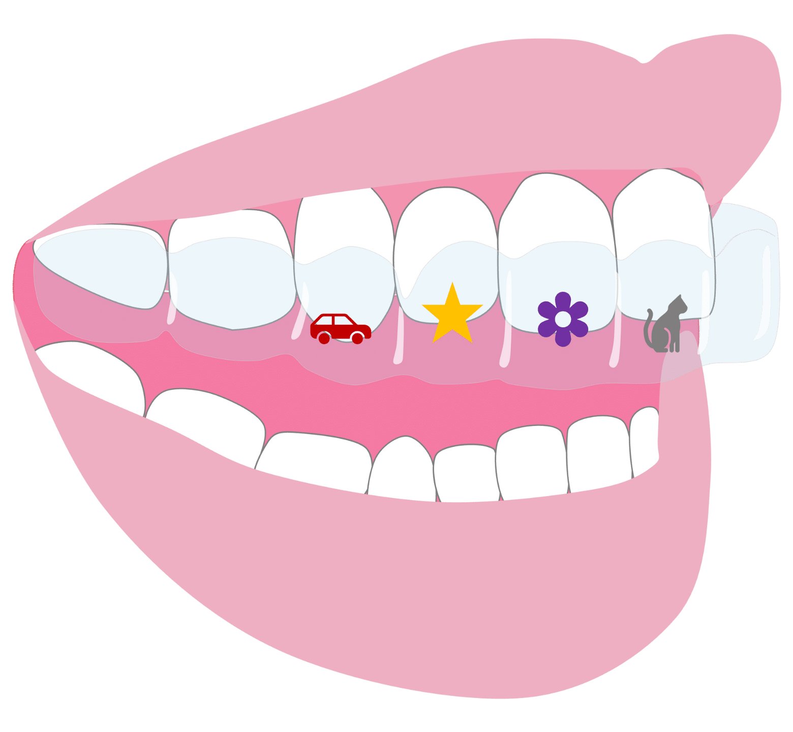 Straight Teeth Options - Hampshire Dentists Pain Free Dentist in Southampton Graphic representation of Invisalign First aligner on teeth