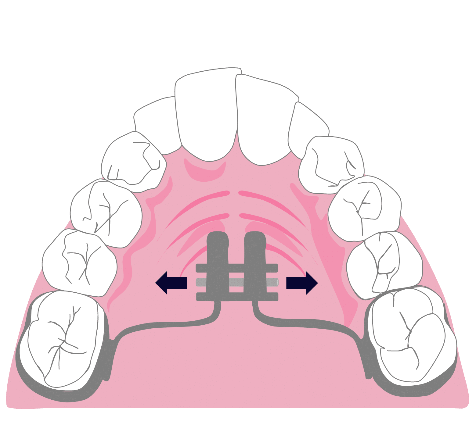 Straight Teeth Options - Hampshire Dentists Pain Free Dentist in Southampton Graphic representation of hyrax rapid expansion device attached to top teeth across palate