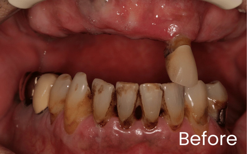 Full mouth implants (All on 4) - Hampshire Dentists Pain Free Dentist in Southampton Full front retracted view of multiple missing top teeth before transformation with dental implants