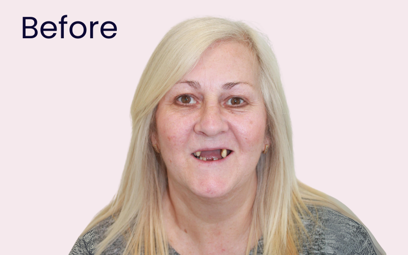 Image of patient before undergoing dental implant treatment to stabilise denture at Hampshire Dentists in Southampton