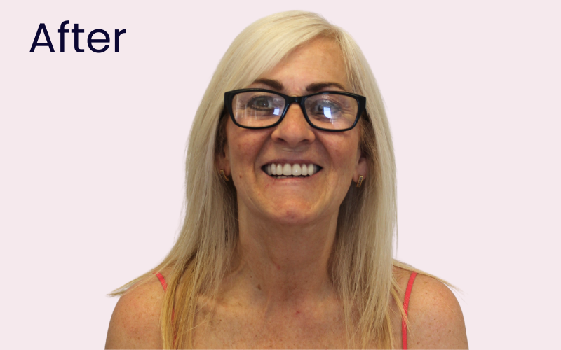 Image of patient after undergoing dental implant treatment to stabilise denture at Hampshire Dentists in Southampton